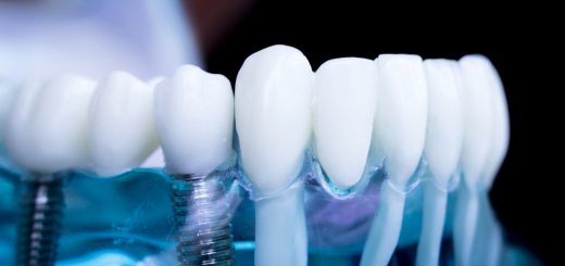 Durere după inserarea unui implant dentar